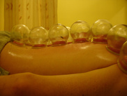 Cupping in Acupuncture