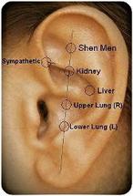 Ear Acupuncture and the NADA protocol