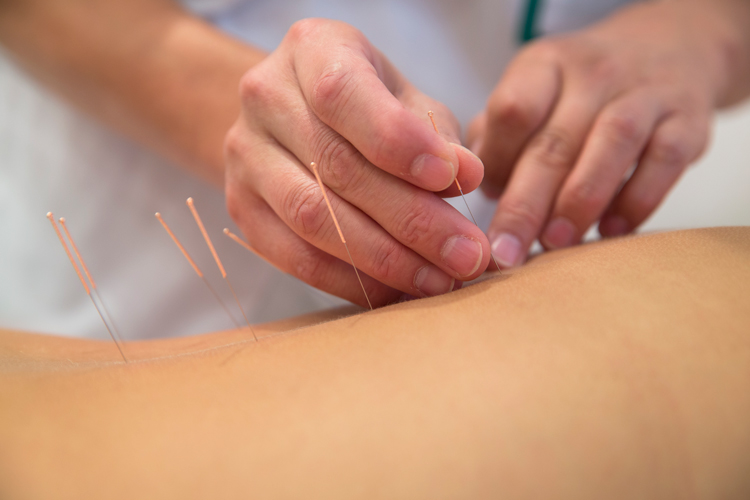Acupuncture Information and Forms